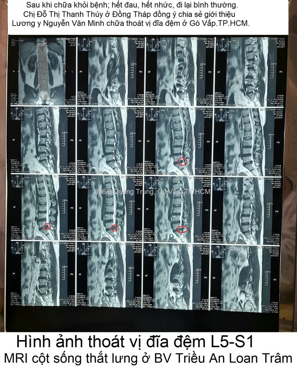 hinh-anh-thoat-vi-dia-dem-L5 S1